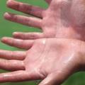 Hiperhidrosis palmar: cuando el sudor no te deja tocar cómodamente