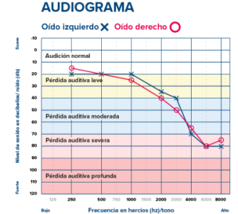 Web2-Hearing-Loss-Degree-Audiogram-ES-548.png